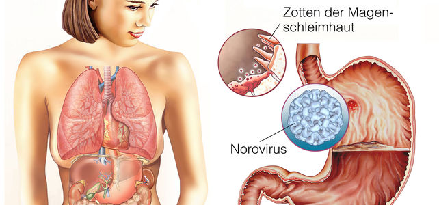 Norovirus im Ferienlager